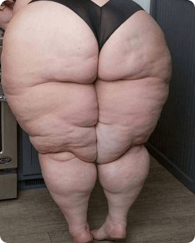 巨体女性の脹脛